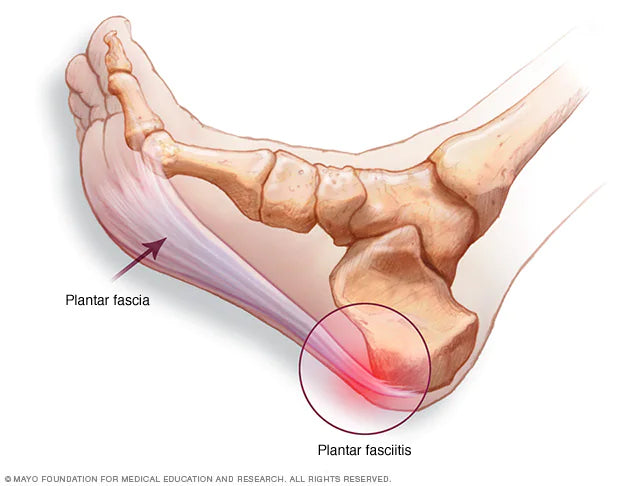 Medical diagram showing plantar fasciitis inflammation in the heel and the plantar fascia ligament in the foot.