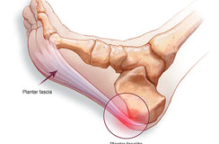 5 Tried and Tested Ways to Fix Plantar Fasciitis